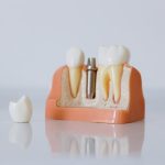 Jakie są różnice między implantami zębowymi a protezami?